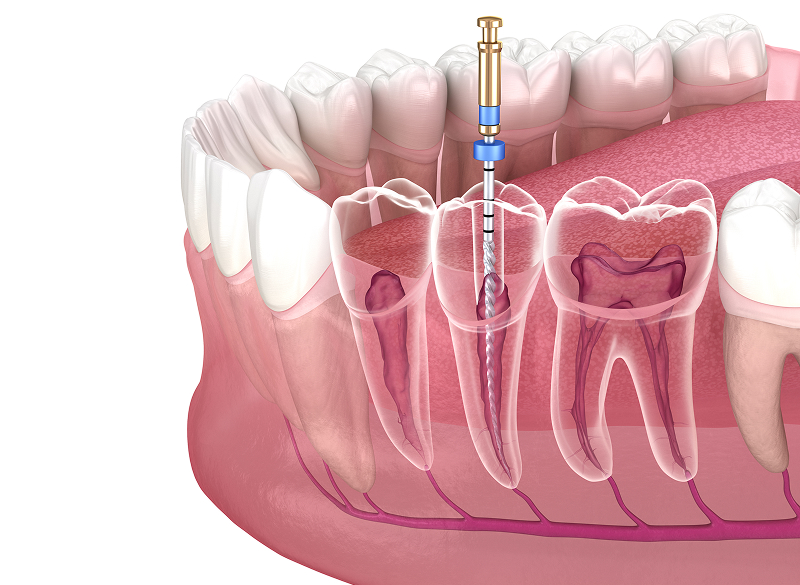 歯内療法
